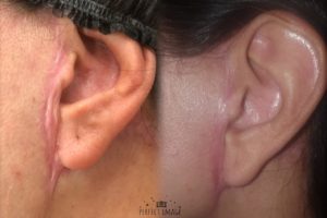 peeling-resultados-curso-treinamento-workshop-melasmas-acne-espinha-problema-de-pele-dois