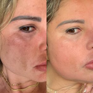 peeling-resultados-curso-treinamento-workshop-melasmas-acne-espinha-problema-de-pele-seis