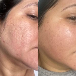 peeling-resultados-curso-treinamento-workshop-melasmas-acne-espinha-problema-de-pele-sete