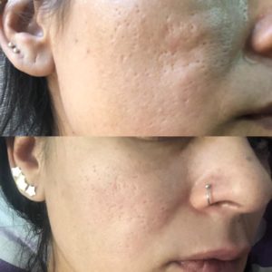 peeling-resultados-curso-treinamento-workshop-melasmas-acne-espinha-problema-de-pele-tres