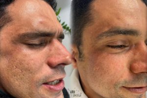 peeling-resultados-curso-treinamento-workshop-melasmas-acne-espinha-problema-de-pele-um